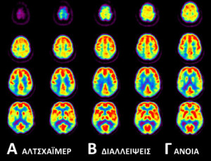 brain-diseases-03